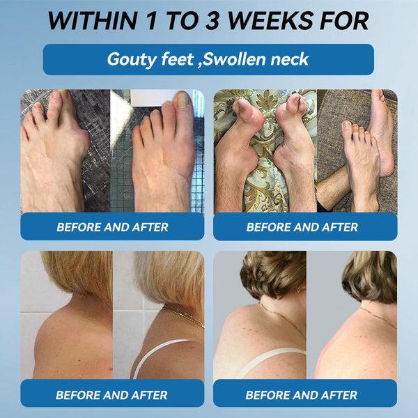 Croaie"ยฎ๐บ๐ธ ๐๐๐-๐๐๐ ๐๐จ๐ข๐ง๐ญ ๐๐๐๐ฅ๐ข๐ง๐  Capsules, 1000MG, Non-GMO, Gluten-Free, 60 Capsules๐ฆดTreats Arthritis, Neuropathy, Rheumatism, Sports Injuries & More๐